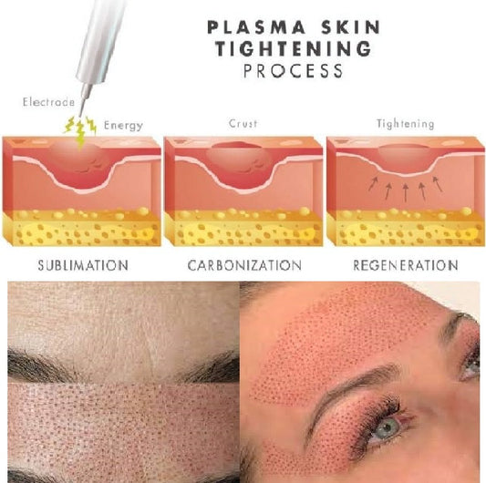 Achieving Youthful Skin with Plasma Fibroblast Therapy flawlesseternalbeauty