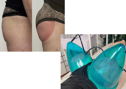 Butt Vacuum Therapy (Butt Cupping) flawlesseternalbeauty