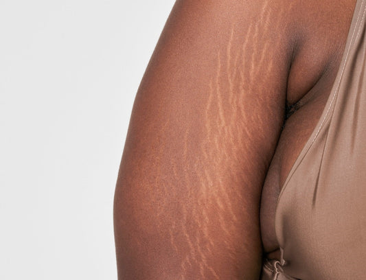 Stretch Marks: Causes and Treatment Options flawlesseternalbeauty