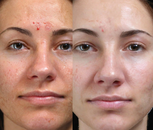 The Comprehensive Guide to Chemical Peels flawlesseternalbeauty