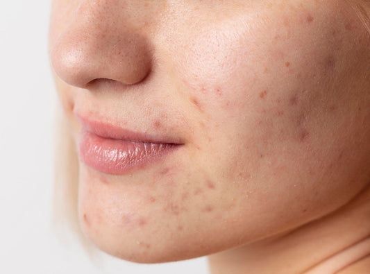 The Impact of Acne on Self-Confidence flawlesseternalbeauty