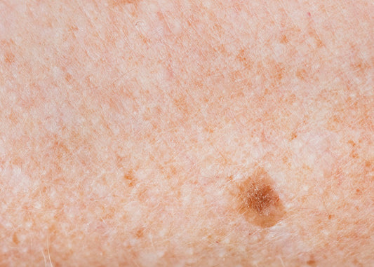 Understanding Lentigo (Liver Spots) flawlesseternalbeauty