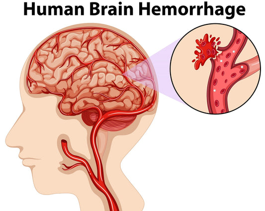 Understanding the Connection Between Brain Bleeds and Amyloid Deposits in Older Adults flawlesseternalbeauty