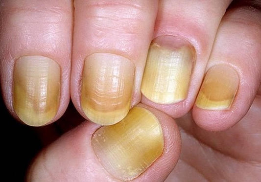 Yellow Nails Syndrome flawlesseternalbeauty