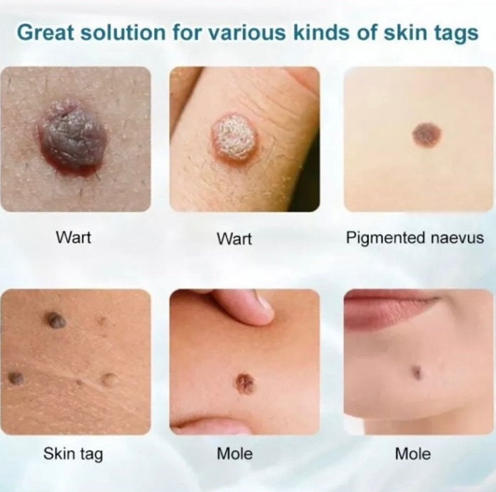 Apgar Herbal Skin Tag Removal Cream 5g flawlesseternalbeauty