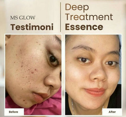 Ms Glow Deep Treatment Essence with Salmon DNA