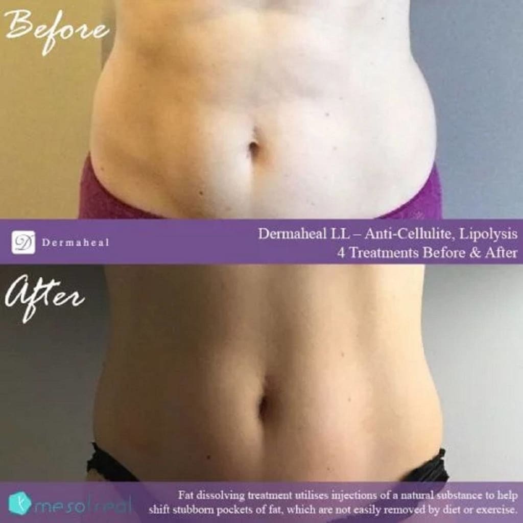 Dermaheal LL Fat and Cellulite Solution